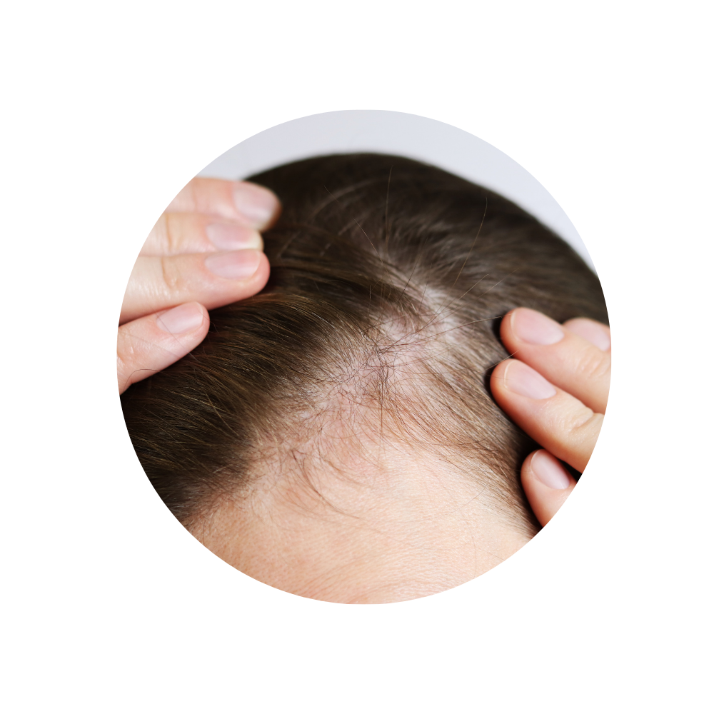 Geheimratsecken kaschieren