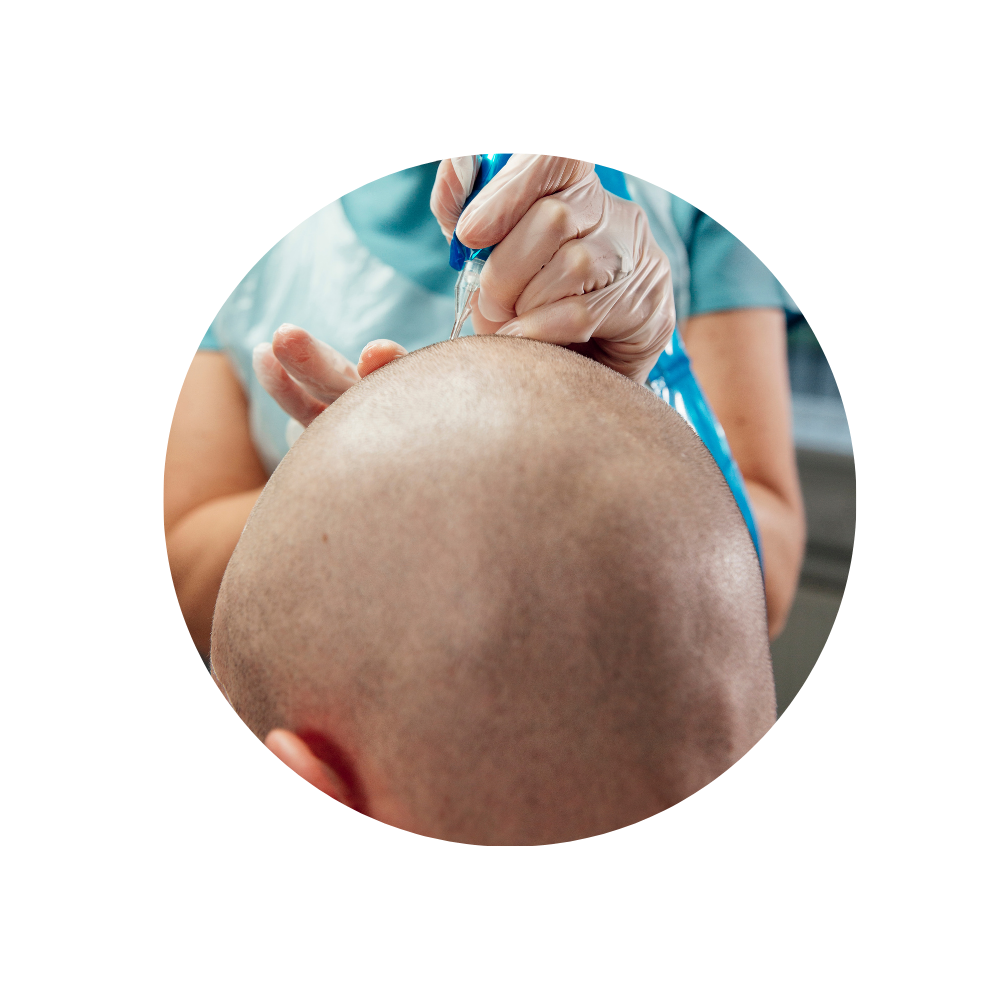 Glatze Haarwurzeln optisch verdichten